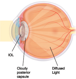 Cross section of eye showing diffused light shining through IOL and cloudy posterior capsule.