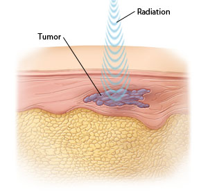 Cross section of skin showing high-energy radiation waves penetrating to reach a tumor.