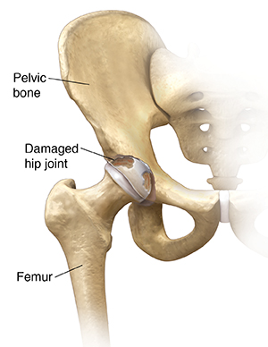 Front view of the hip joint with arthritis.