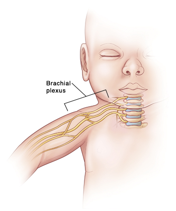 Outline of baby showing nerves coming from spine in neck and going down arm. Brachial plexus is group of nerves in neck and shoulder.