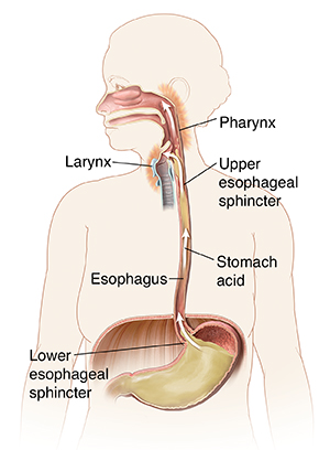 Outline of woman showing mouth, esophagus, and stomach. Arrows show stomach acid flowing up esophagus to irritate back of throat.