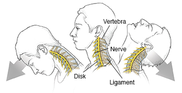 Side view of woman's head and neck showing neck vertebrae, ligaments, and nerves during whiplash: neutral position, in hyperflexion, and in hyperextension.