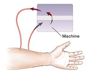 Closeup of arm showing fistula between artery and vein and catheters moving blood to and from dialyzer for hemodialysis.