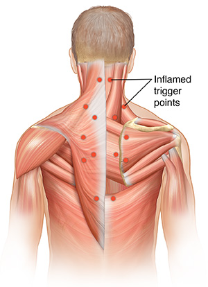 Male torso showing superficial muscles of back on right side and deep muscles of back on left. Inflammed trigger points are shown.