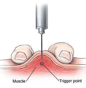 Cross section of skin and muscle with two fingers compressing muscle for needle insertion.
