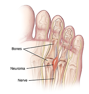 Bottom view of foot showing bones, nerves, and a neuroma between two bones.