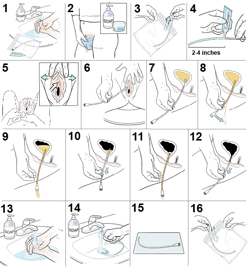 16 steps showing how a female inserts a urinary catheter.