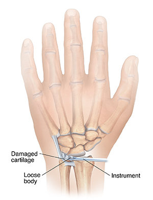 Back view of hand showing instrument removing loose body from joint in wrist.