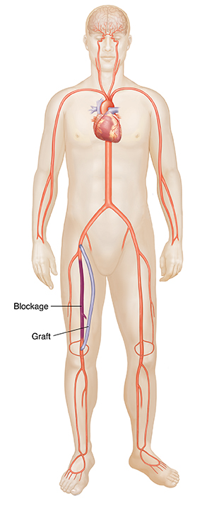 Front view of male figure showing femoral popliteal bypass.