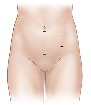 Front view of female abdomen showing possible incision sites for pelvic laparoscopic surgery.