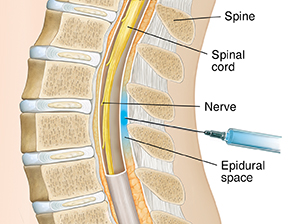 Cross section of lower spine with needle inserted just outside sac surrounding spinal cord.