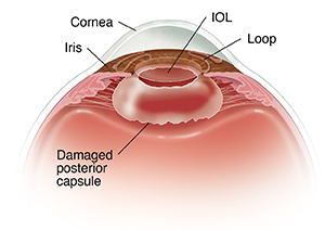 Side view cross section of front of eye showing intraocular lens in anterior chamber.