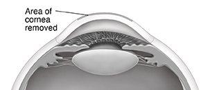 Cross section side view of front of cornea showing area of cornea removed by laser.