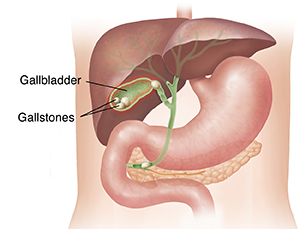 Outline of torso showing liver and stomach with cross section of gallbladder with stones.