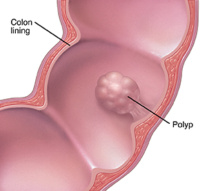 Cross section of segment of colon showing polyp.