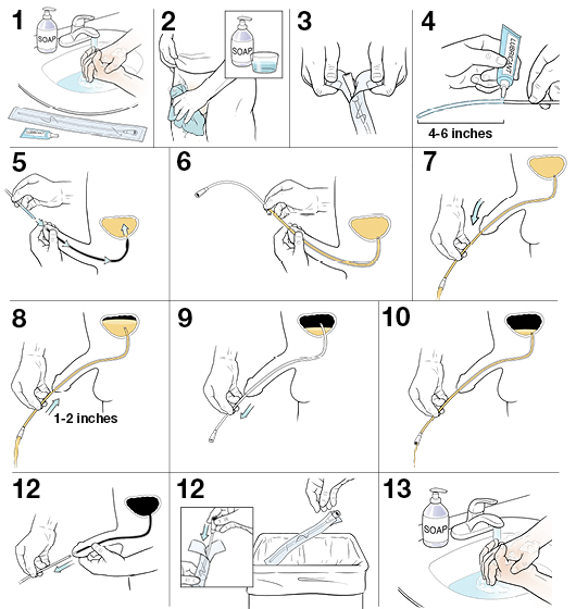 13 steps to inserting a disposable urinary catheter
