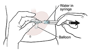 Front view of abdomen showing gastrostomy tube, balloon, and syringe. Hands holding syringe in gastrostomy tube, drawing water out of balloon.