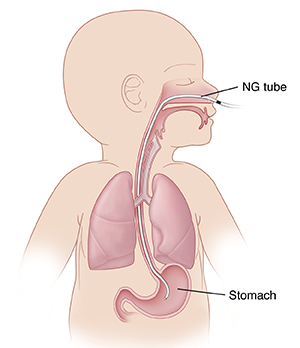 Outline of baby showing NG tube inserted through nose into stomach.