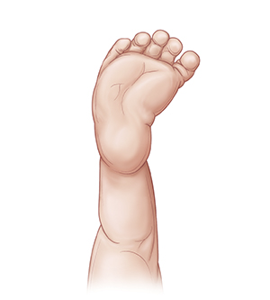 Back view of baby's leg showing bottom of foot with front part of foot turned inward.
