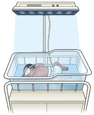 Baby with eyes covered under phototherapy lamp in incubator.