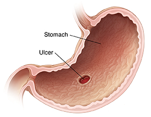 Cross section of stomach showing ulcer in stomach lining.