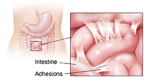 Outline of woman showing stomach and intestines. Inset shows adhesions.