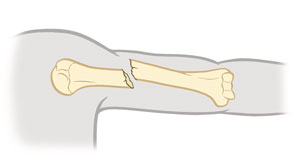 Upper arm bone showing a closed fracture.