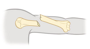 Upper arm bone showing open fracture.