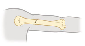 Upper arm bone showing nondisplaced fracture.