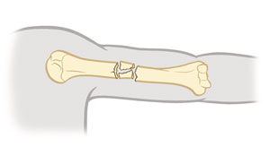 Upper arm bone showing comminuted fracture.