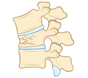 Side view of compression fracture in the spine.