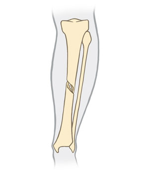Front view of a spiral fracture in the shin.