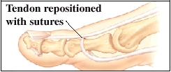 Image of tendon repositioned with suture