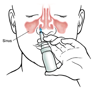 Front view of face showing sinuses and proper technique for using nasal spray.