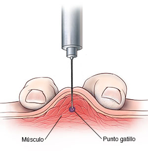 Corte transversal de piel y músculo con dos dedos que comprimen el músculo para insertar la aguja.