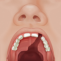 Vista frontal de la boca abierta de un niño donde se ve una hendidura total del paladar.