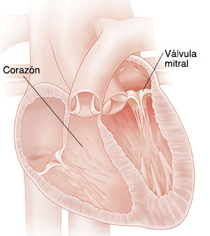 Corte transversal del corazón que muestra una válvula mitral con insuficiencia. 