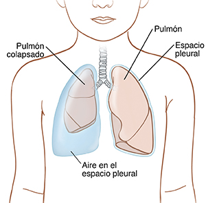 Contorno de un niño donde pueden verse los pulmones en el pecho. El pulmón izquierdo es normal y está rodeado de espacio pleural delgado. El pulmón derecho se encuentra colapsado y el espacio pleural se está llenando de aire.