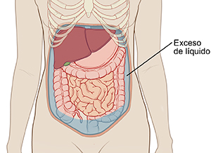Contorno del abdomen de una mujer donde pueden verse los órganos abdominales. Hay líquido que está llenando el abdomen alrededor de los órganos. 