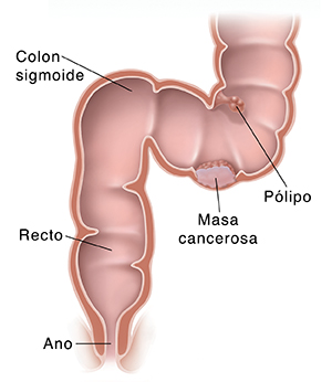 Corte transversal del colon sigmoide, recto y ano donde pueden verse el cáncer y un pólipo.