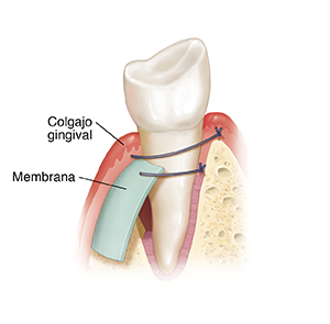 Colocación de membrana en colgajo gingival cerca del diente.