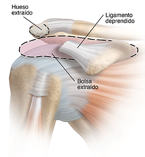 Imagen de la articulación del hombro que muestra hueso y bolsa extraídos y ligamento deprendido