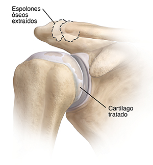 Articulación del hombro en donde se muestra la extracción de espolones óseos y el tratamiento del cartílago