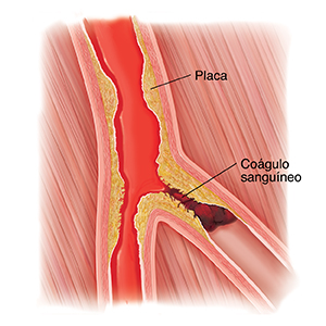 Corte transversal de una arteria periférica con acumulación de placa y un coágulo sanguíneo.