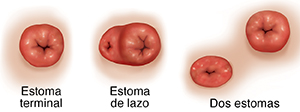 Vista frontal de un estoma terminal, un estoma en asa y dos estomas.