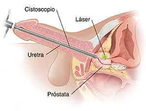 Corte transversal de la próstata que muestra un cistoscopio insertado en la uretra y la próstata. Un rayo láser que sale del cistoscopio extirpa tejido prostático.
