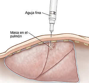 Corte transversal de una pared corporal donde puede verse una aguja tomando una muestra de tejido de una masa en el pulmón.