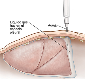 Corte transversal de una pared corporal donde puede verse una aguja extrayendo líquido pleural.