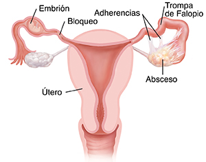 Vista frontal de un útero con complicaciones causadas por una enfermedad inflamatoria pélvica, como un embarazo ectópico, adherencias, obstrucciones y abscesos.