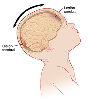 Vista lateral de la cabeza de un bebé inclinada hacia atrás, que muestra el cerebro en el interior. Las flechas muestran la cabeza moviéndose hacia adelante y hacia atrás y las lesiones en la parte delantera y trasera del cerebro.